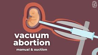 How Do Vacuum Abortions Work?