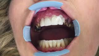 Houston Cosmetic Dentist...Smile Makeover With Veneers, Crowns and Implants