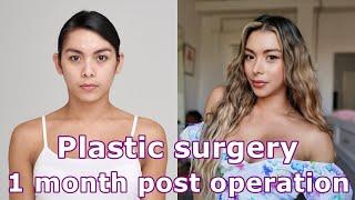 Transgender Facial Feminization surgery (FFS) in Korea : 1 month post operation review