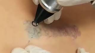 Q Switch Laser Tattoo Removal in NYC | Get Rid of Tattoos, Dr. Rokhsar