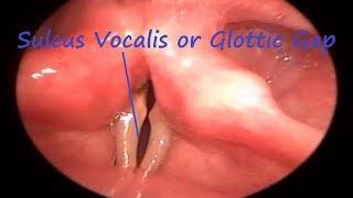 Sulcus Vocalis or Glottic Gap on Rigid Video Laryngoscopy