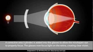 Astigmatism explained: Easily Corrected With A Cylinder in Your Eyewear Glasses