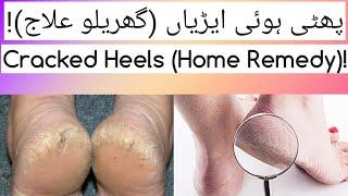 (پھٹی ہوئی ایڑیاں (گھریلو علاج)!) Cracked Heels (Home Remedy)!  |#YouTubeShorts