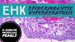 Epidermolytic Hyperkeratosis (EHK): 5-Minute Pathology Pearls