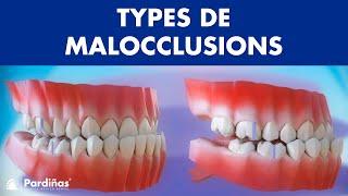 Malocclusion – Types de malocclusions dentaires ©