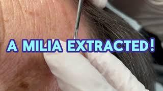 A Milia Extracted