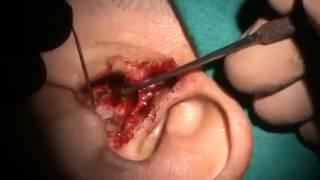 Dr Prashant Kewle Operation ENDAURL T'PLASTY