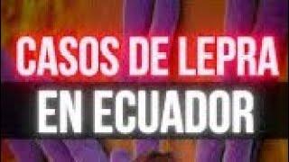 ️ PROFECÍA CUMPLIDA EN ECUADOR SOBRE LEPRA. NOTICIA DE MESES PASADOS PERO ES PARTE DE LO ANUNCIADO