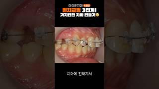 교정 고무줄로 발치 공간 메우기 #shorts