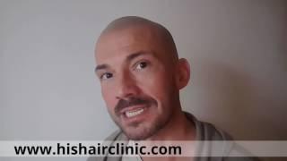 Karl’s Scalp Micropigmentation Review - HIS Hair Clinic for Hair Loss