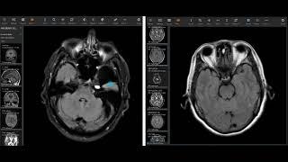 Brain MRI Video Report (Full Length)