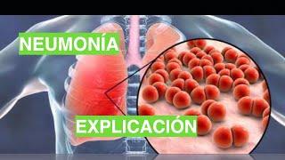 ¿Cómo se produce la Neumonía? Fisiopatología de la Neumonía.