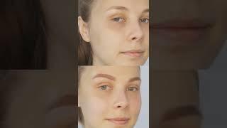 Autologous Lipocyte Micronized Injection #ALMI for rejuvenation and regeneration! #fattransfer