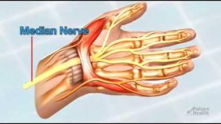 Treatment of Carpal Tunnel Syndrome by Future Health Software