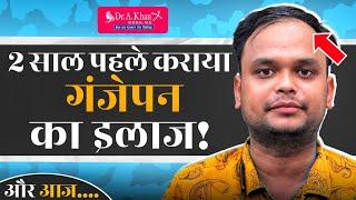 "गंजेपन के इलाज के 2 साल बाद कितने बाल बचे?" | Dr. A Khan Review | Hairloss Treatment