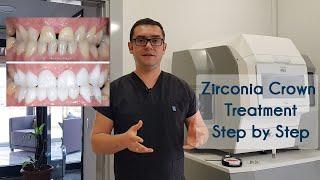 Zirconia Crown Treatment in Turkey & How We Produce Zirconia Crowns in Elit Dental Clinic Kusadasi