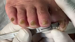 I Tried Every Nail Fungus Treatment, Here Are The Results