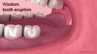 Wisdom tooth eruption. 3D Animation.