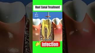 Root Canal Treatment, Infected Tooth Apex