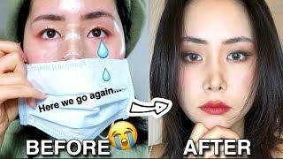 Something BAD Happened To My Nose... | Rhinoplasty Revision Story