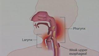 Good Question: What Causes Laryngitis?