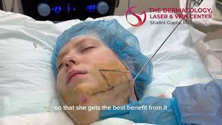 Vaser Liposuction and Facetite for Double Chin | Dr. Shalini Gupta