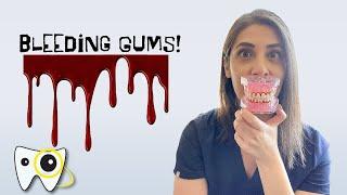 Bleeding Gums! | Why do your gums bleed and how to treat them