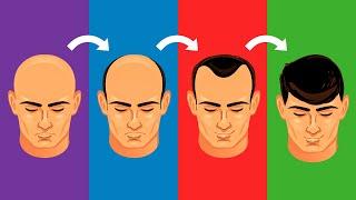 Top 5 Hair Loss Solutions (For Men)