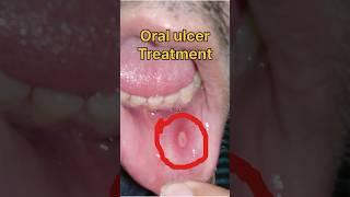 Oral ulcer treatment #mouthulcer #health #ulcer #healthvideos