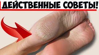 5 полезных советов для тех, кто страдает от шелушения кожи на пятках ног!