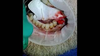 Management of a Bleed 6 Days after Dental Extraction with Gelfoam and Tranexamic Acid.