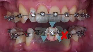 Clinical Tip: Stop Position｜【Chris Chang Ortho】CC439