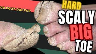 Hard Scaly Big Toe