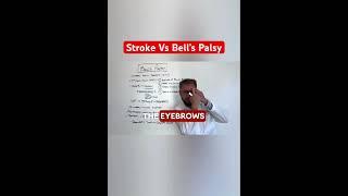 The Key Difference in Diagnosing a Stroke vs Bell’s Palsy | Brain Expert Explains