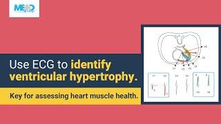 How to recognize ventricular hypertrophy