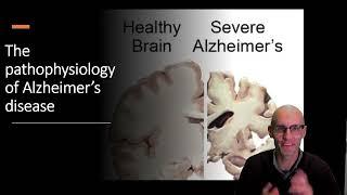 What causes Alzheimer's disease: The pathophysiology of Amyloid.