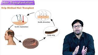 Permanent Hair transplant - Procedure, Types, side effects, before and after results and recovery