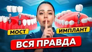 Ошибки, которых можно избежать! Имплант или Мостовой Протез: вся правда от стоматолога