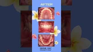 치간사이삭제를 통한 치아교정 #비발치치아교정 #치간삭제를통한공간확보 #치아교정 #orthodontics #단기치아교정