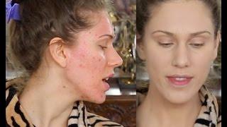 Acne Scar Foundation Routine - Full Coverage Flawless Makeup Tutorial - Pores & Ice Pick Scarring