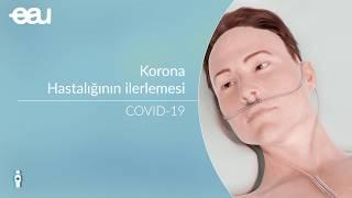 Koronavirüs COVID-19 - Hastalığının ilerlemesi