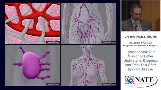 Lymphedema: Our Mission to Better Understand Diagnose and Treat This Often Ignored Disease