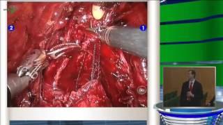 Gozen S - Robot assisted radical prostatectomy