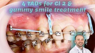 gummy smile & Cl 2 treatment using IZC & frontal TADs, Mini screw insertion power chain installation