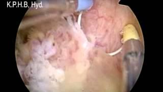 BLADDER TUMOR REMOVAL with Bipolar- Preeti Urology and Kidney Hospital