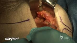 AIP/STOPPA Approach & ASIS Osteotomy by Claude Sagi, M.D. & Marcus Sciadini, M.D.