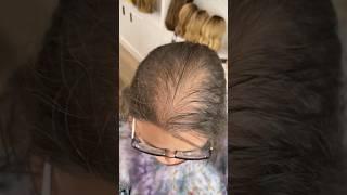 The Most REALISTIC Hair Topper For Hair Thinning  Watch This!