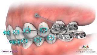 Temporary Anchorage Device or TAD - Orthodontic Appliance