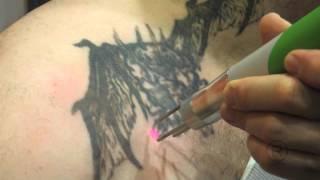 Demonstration of Laser Tattoo Removal