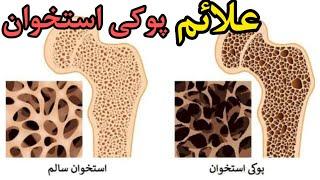 پوکی استخوان و علائم آن|پوکی استخوان چیست|علت پوکی استخوان